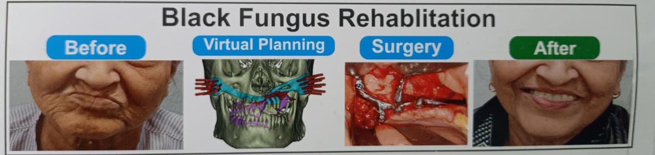 Black fungus rehabilitation — before and after treatment