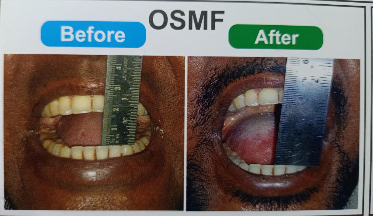 OSMF (submucous fibrosis) — before and after treatment