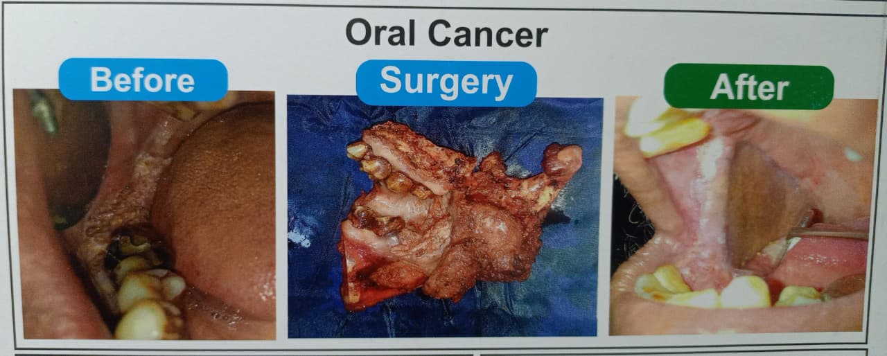 Oral cancer surgery — before and after treatment