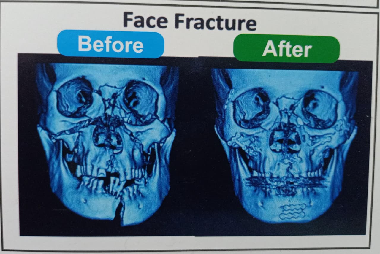 Face fracture fixation — before and after treatment